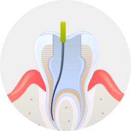 충치 및 신경관 제거